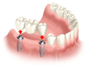 Bridge Implants
